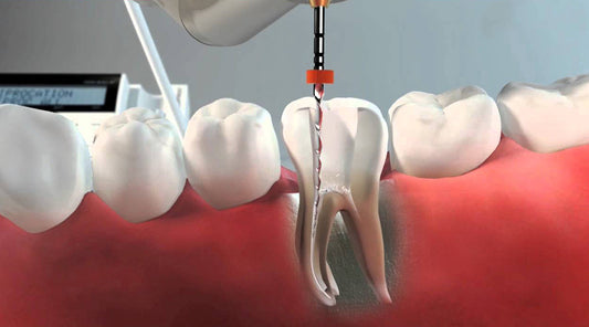 Endodoncia